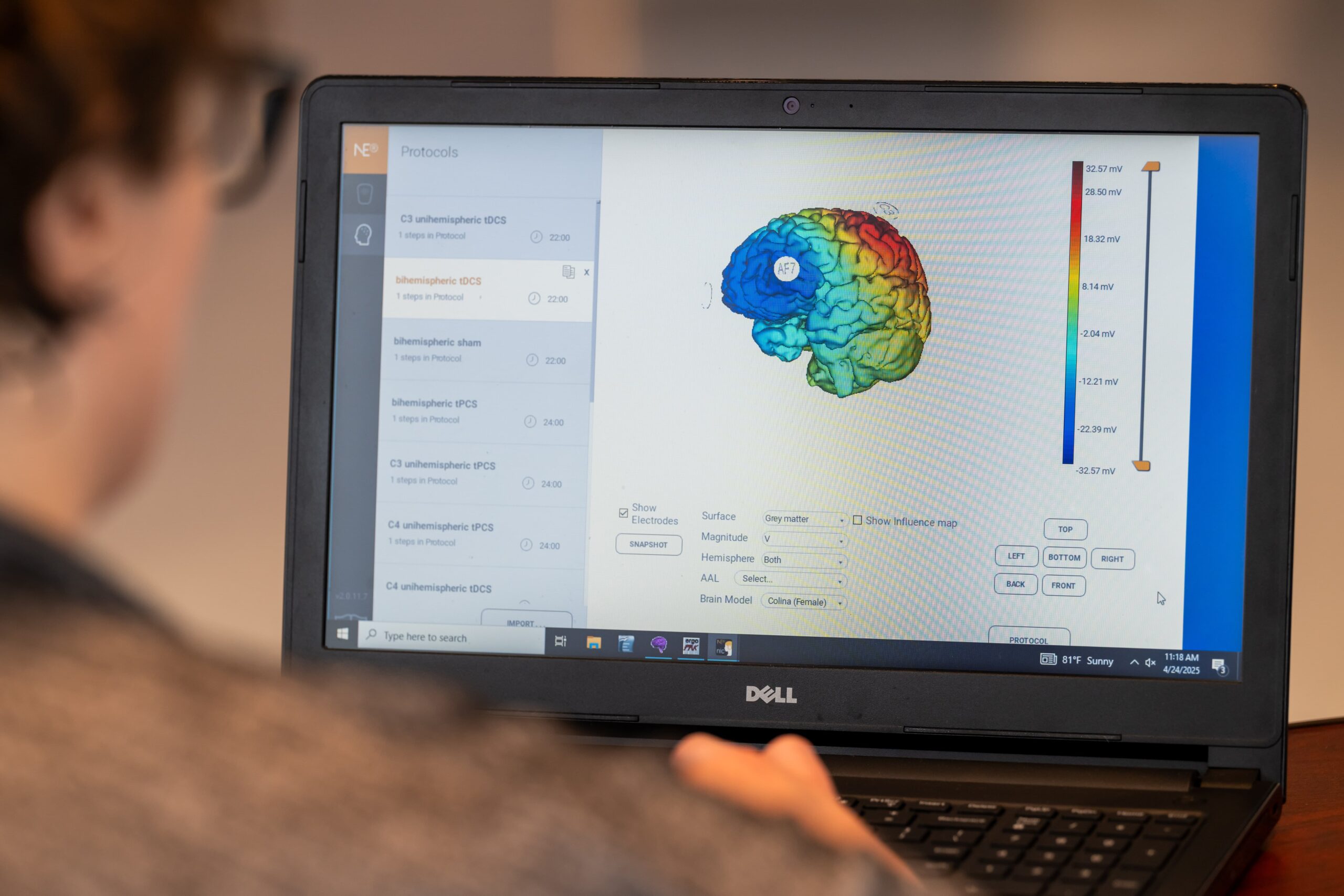 A person looks at a laptop screen displaying a colorful 3D brain scan with data analysis and protocols on the left side of the screen. The brain image includes a color-coded legend on the right.